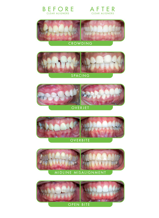 Orthodontics in Fountain Valley